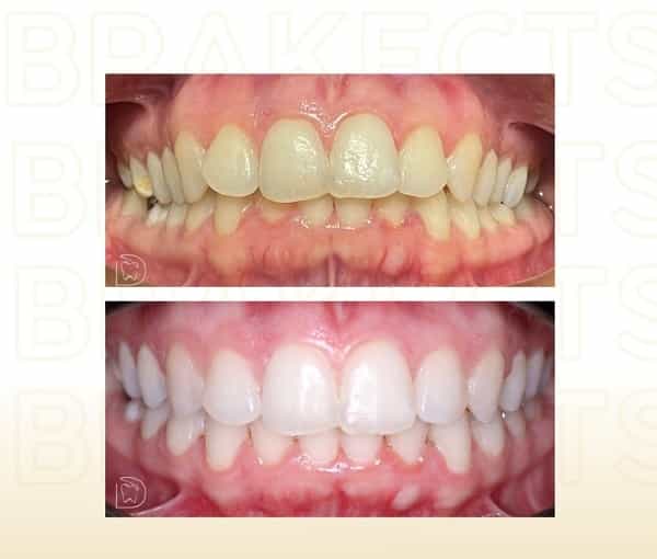 Imágenes de Antes y Después de Tratamientos Dentales en Cancún México