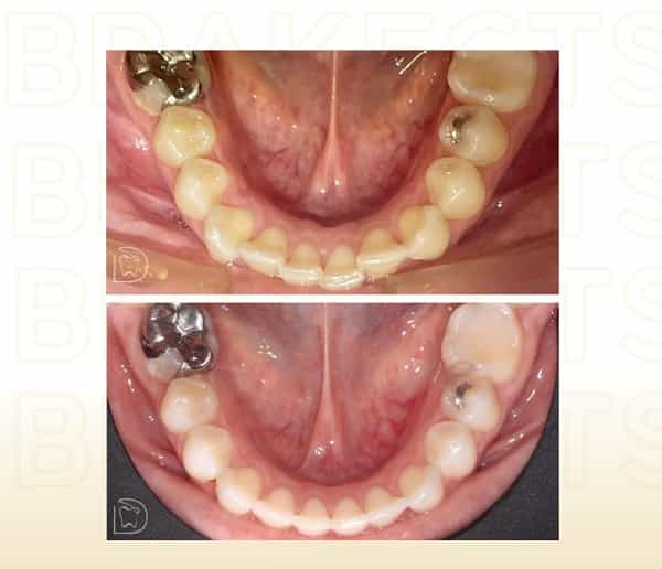 Imágenes de Antes y Después de Atención Dental en Cancún México