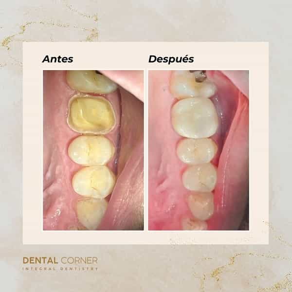 Imágenes de antes y después en Dental Corner en Cancún, México