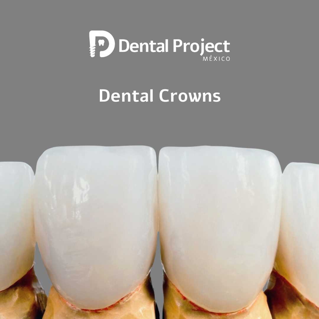 Paquete de coronas dentales en Tijuana, México