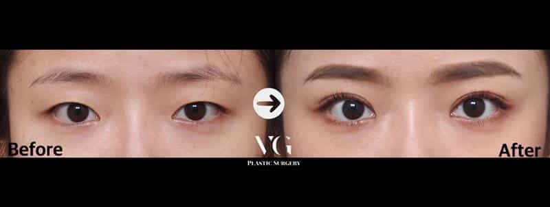 Before and After Eyelid Surgery in Seoul South Korea