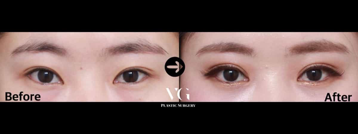 Before and After Eyelid Surgery in Seoul