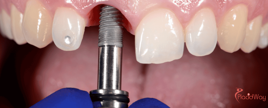 Dental Implants in Mexico