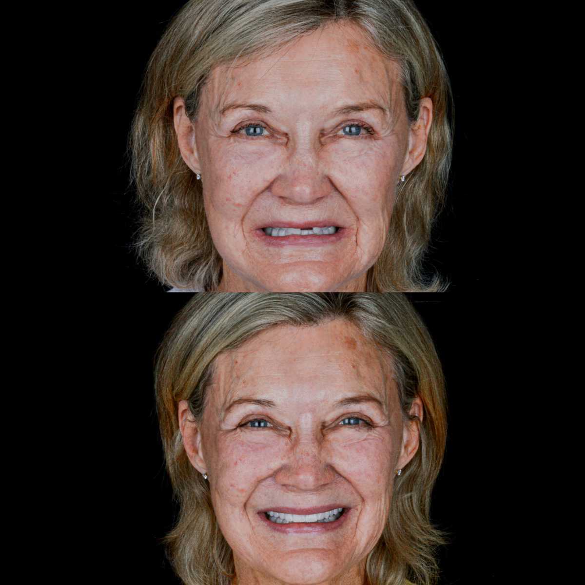 Before and After Smile Makeover in Los Algodones Mexico