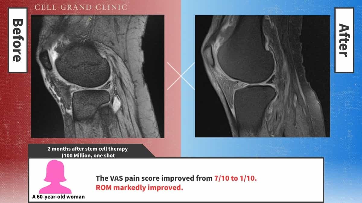 Knee Pain Cases