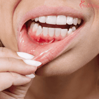What is the Cost for Gum Contouring in Tijuana? 