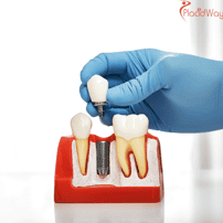 ¿Cuánto cuestan los implantes dentales en Puerto Vallarta?