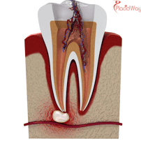What is the Average Price of Root Canal in Istanbul, Turkey?