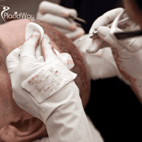 How Can Hair Transplant Doctors in Turkey Restore Your Hair and Confidence?