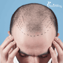  Why Are Turkey Hair Doctors Renowned for Their Expertise in Hair Loss Treatment?
