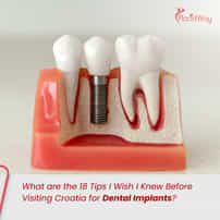 What are the 18 Tips I Wish I Knew Before Visiting Croatia for Dental Implants?