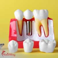 Where Can I Get Dental Implants In Croatia?