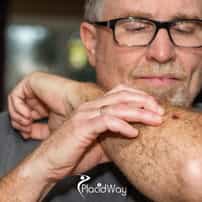 What is the Cost of Skin Cancer Treatment in Turkey?