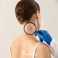 What Immunotherapy Options Exist for Melanoma in Mexico? 