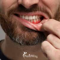 Conozca Sani Dental Group, Los Algodones, México después del trabajo dental