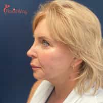 Facial Rejuvenation in Yerevan, Armenia by Boroyan Plastic Surgery Clinic: Before and After Transformation