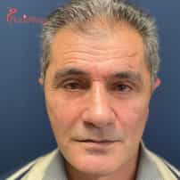 Face Lift Surgery in Yerevan, Armenia by Boroyan Plastic Surgery Clinic: Real Before and After Photos