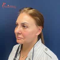 Facial Lifting Surgery in Yerevan, Armenia by Boroyan Plastic Surgery Clinic: Before and After Images