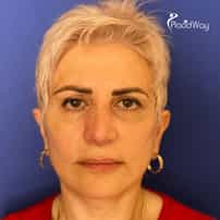 Face Rejuvenation Surgery in Yerevan, Armenia by Boroyan Plastic Surgery Clinic: Before and After Success Story