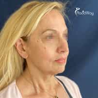 Surgical Facelift in Yerevan, Armenia by Boroyan Plastic Surgery Clinic: Before and After Patient Results