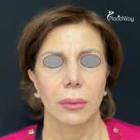 Facelift Lipofilling in Yerevan, Armenia by Boroyan Plastic Surgery Clinic: Real Before & After Results