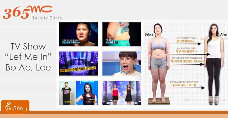 Before and After Surgery - Patient Result - Seoul, South Korea Before and After Surgery - Patient Result - Seoul, South Korea