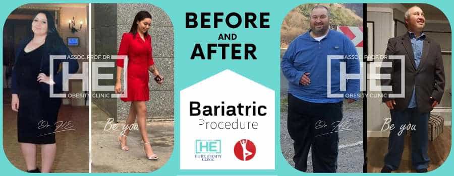 Before and After Bariatric Surgery in Istanbul, Turkey - Dr HE Clinic