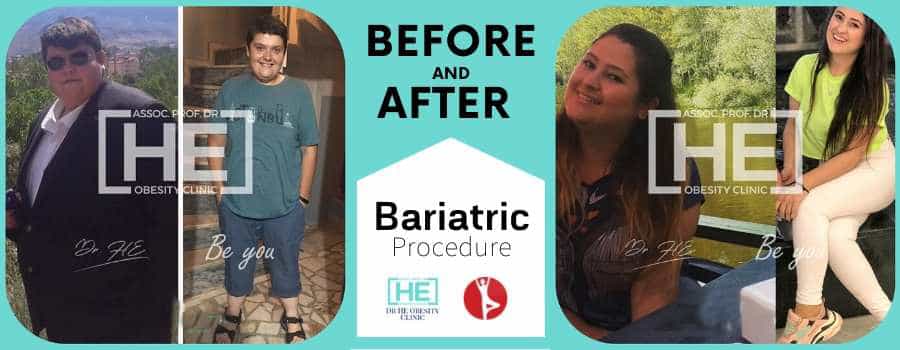 Before and After Gastric Sleeve in Istanbul, Turkey - Dr HE Clinic