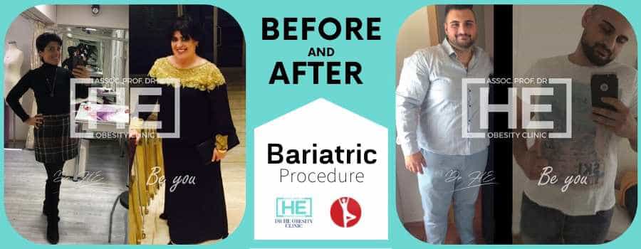 Before and After Gastric Bypass in Istanbul, Turkey - Dr HE Clinic