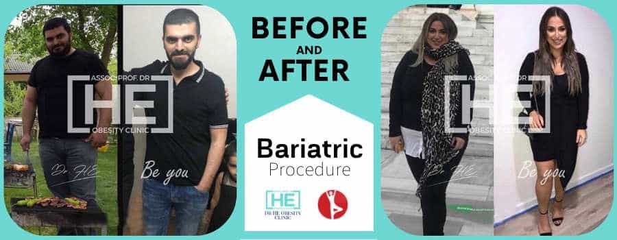 Before and After Lap Band Surgery in Istanbul, Turkey - Dr HE Clinic