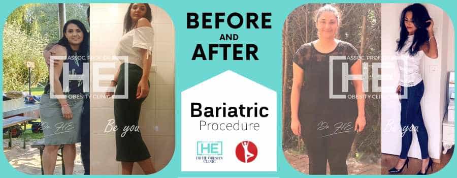 Before and After Gastric Balloon in Istanbul, Turkey - Dr HE Clinic