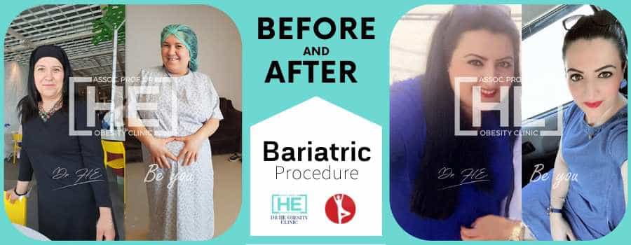 Before and After Obesity Surgery in Istanbul, Turkey - Dr HE Clinic