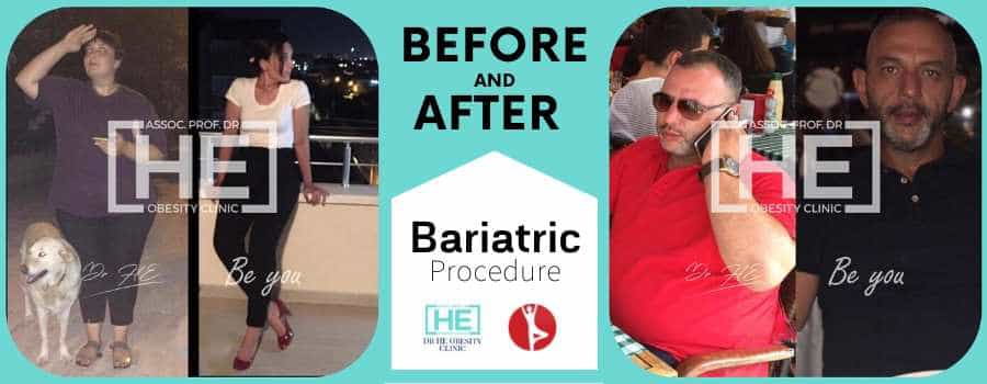 Before and After Sleeve gastrectomy in Istanbul, Turkey - Dr HE Clinic