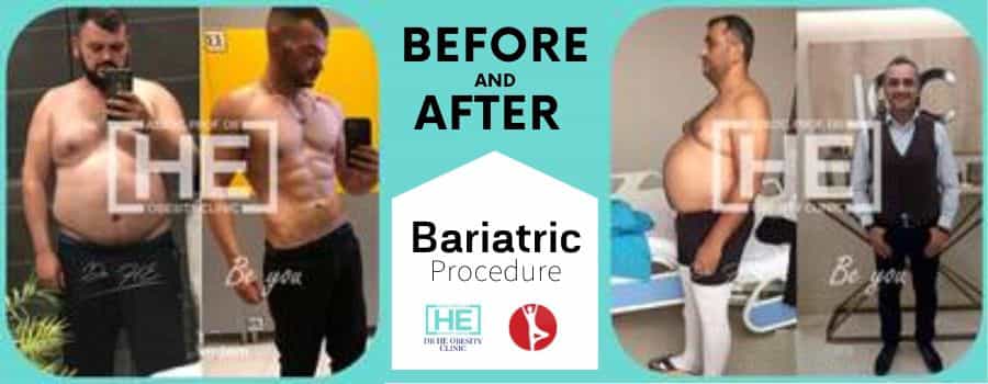 Before and After intra gastric Balloon  in Istanbul, Turkey - Dr HE Clinic