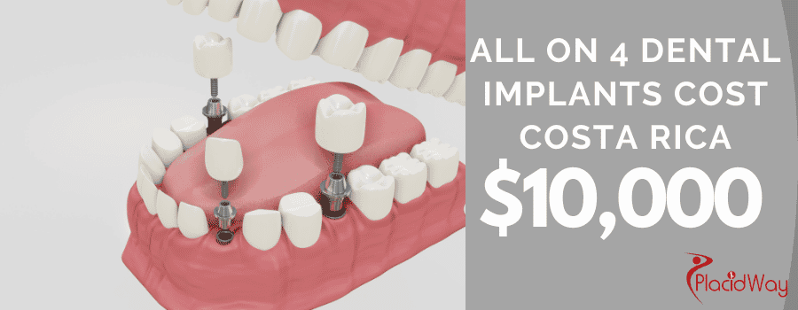 All on 4 Dental Implants Cost in Costa Rica All on 4 Dental Implants Cost in Costa Rica