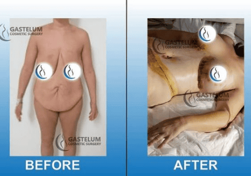 Mommy Makeover in Gastelum Cosmetic Surgery