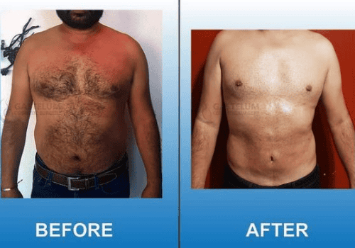 Tummy Tuck in Gastelum Cosmetic Surgery