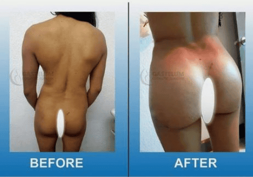 Brazilian Butt Lift in Gastelum Cosmetic Surgery