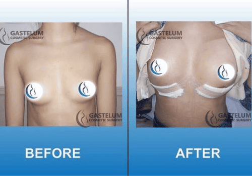 Breast Lift in Gastelum Cosmetic Surgery