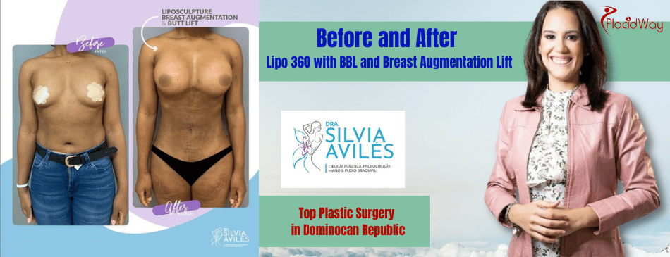 Breast Augmentation Dominican Republic Before and After