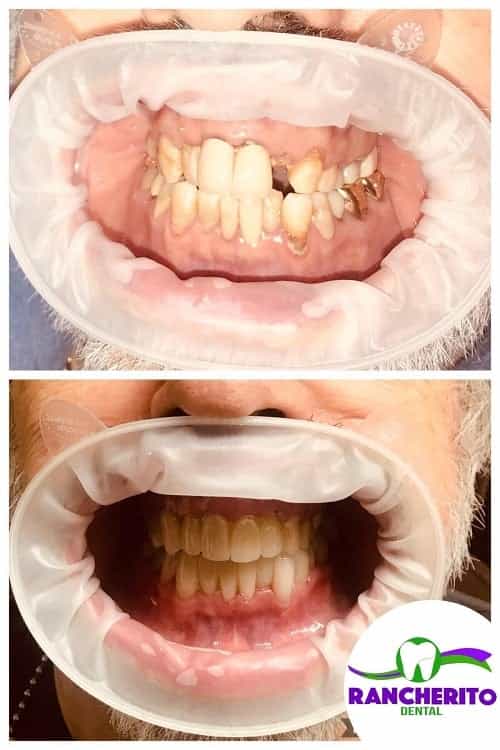 Dental Treatment in Los Algodones Mexico