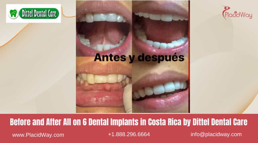 Implantes dentales All on Six en Costa Rica de Dittel Dental Care: antes y después