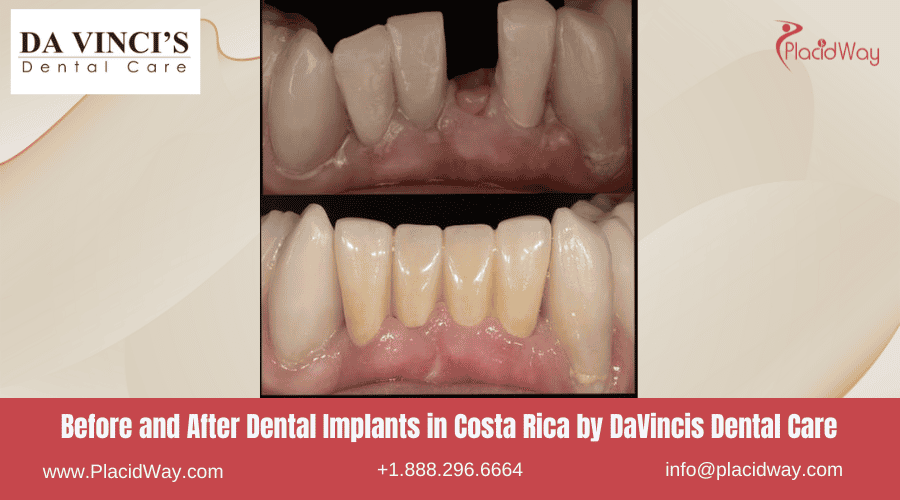 Dental Implants in Costa Rica by Da Vinci - Before and After