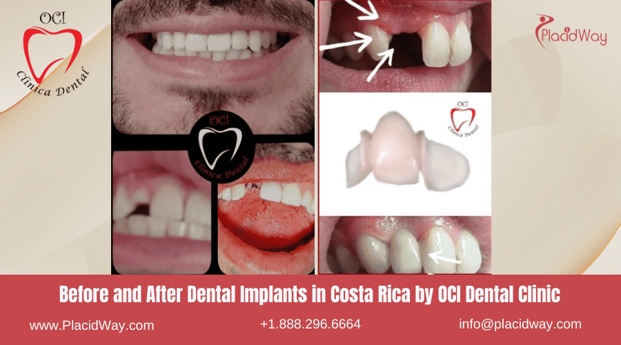 Dental Implants in Costa Rica Cost Saving Dental Work