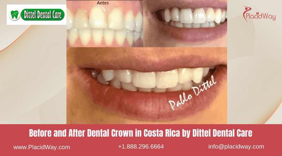 Dental Crowns in Costa Rica by Dittel Dental Care - Before and After