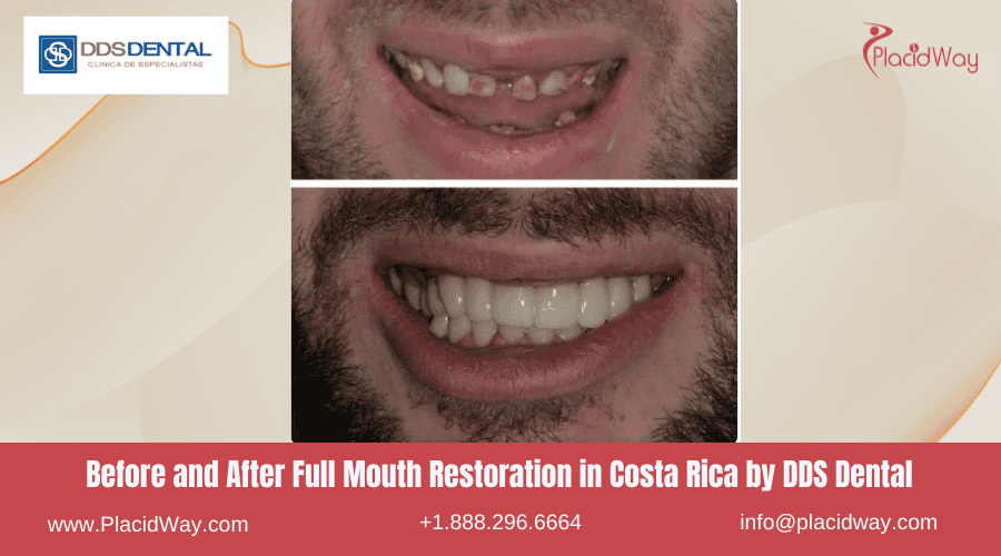 Full Mouth Restoration in Costa Rica by DDS Dental - Before and After