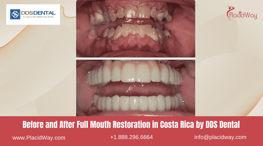 Full Mouth Restoration in Costa Rica by DDS Dental Clinic - Before and After