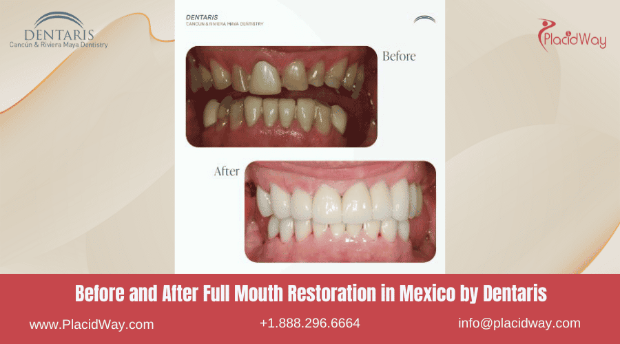 Full Mouth Restoration in Mexico Before and After Image by Dentaris