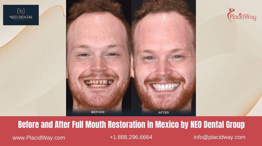 Full Mouth Restoration in Mexico Before and After Image by NEO Dental Clinic