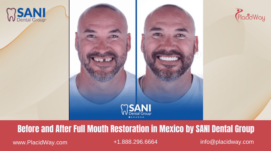 Full Mouth Restoration in Mexico Before and After Image by SANI Dental